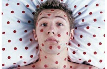 Что нужно знать о кори?