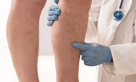 Как предотвратить образование тромбов в сосудах и кто находится в группе риска. Комментирует врач-кардиолог