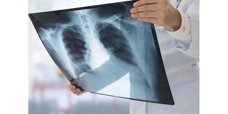 Смертность снизилась в 4,5 раза. Прогресса в лечении туберкулеза достигли в Беларуси