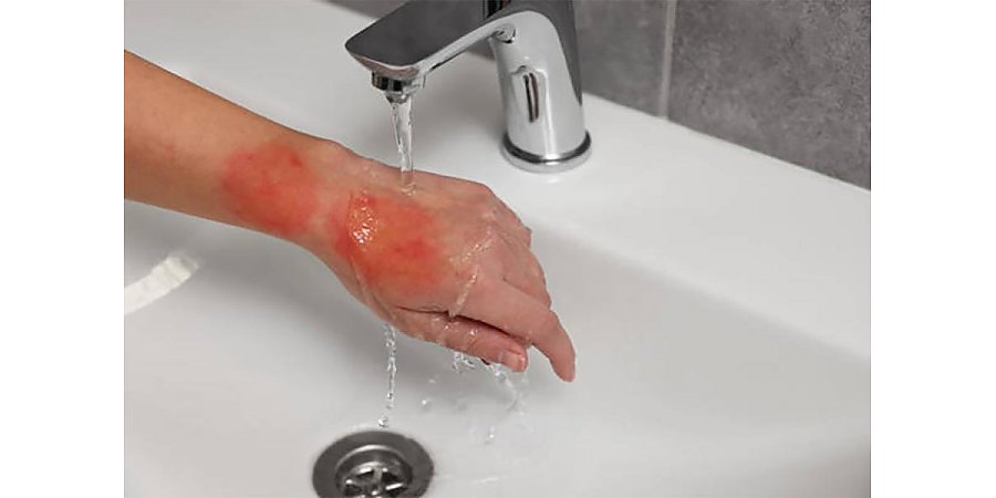 Что делать, если обжегся кипятком? Врач дала пошаговую инструкцию