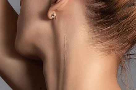 Мази от рубцов бесполезны? Как заживить рану без шрама