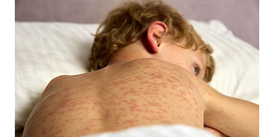 Победите КОРЬ вакцинацией, рекомендуют специалисты Вороновского районного ЦГЭ