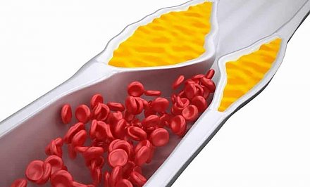 Названы 6 натуральных продуктов от закупорки артерий