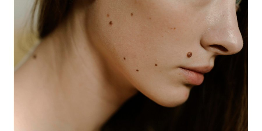 Это не родинка! Какие образования могут появляться на коже и из-за чего?