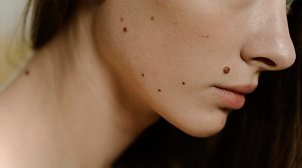 Это не родинка! Какие образования могут появляться на коже и из-за чего?